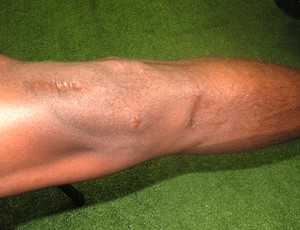 marcas da cirurgia no joelho de Maicosuel (Foto: André Casado / Globoesporte.com)