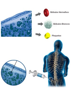 transplante de medula óssea (Foto: Editoria de Arte/Globoesporte.com)