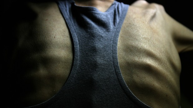 anorexia (Foto: Joel Saget/AFP)