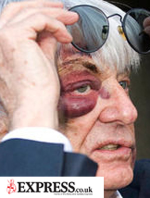 Bernie Ecclestone, olho machucado