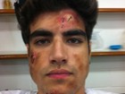 Caio Castro posta foto com ferimentos de mentirinha