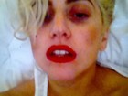 Depois de acidente, Lady Gaga posta foto com aparência abatida
