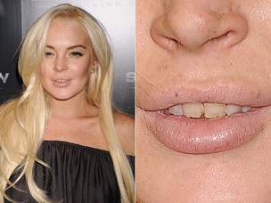 Lindsay Lohan aparece com os dentes podrinhos (Foto: Getty Image)