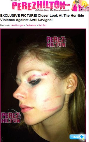Perez Hilton mostra Avril Lavigne toda machucada (Foto: Reprodução Perez Hilton)