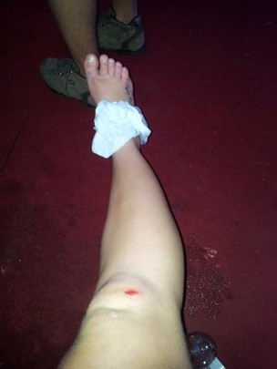 Paulinha e seu pé machucado (Foto: Reprodução/Twitter)