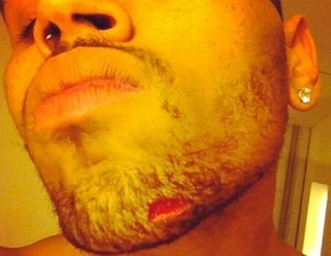 Chris Brown machucado (Foto: Twitter/Reprodução)