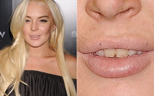 Lindsay Lohan aparece com os dentes podrinhos (Foto: Getty Image)