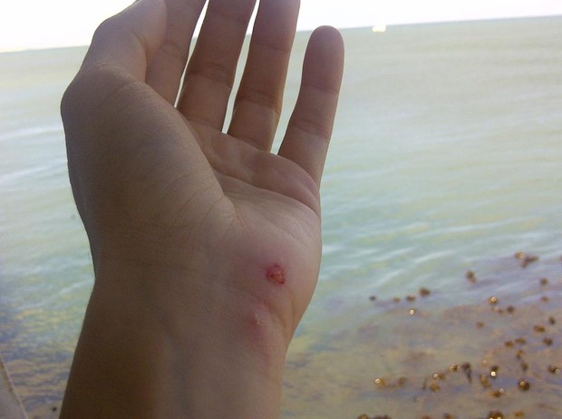 A mão de Shakira, ferida devido ao ataque de um leão-marinho (Foto: Reprodução/Facebook)
