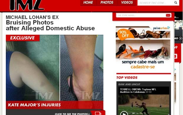 Ex-mulher de Michael Lohan mostra hematomas após agressão (Foto: TMZ)