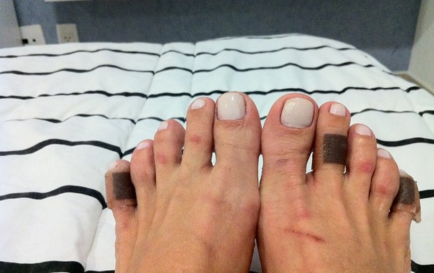 Antônia Fontenelle posta foto dos pés machucados no Twitter (Foto: Twitter / Reprodução)