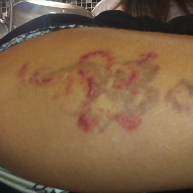 Viviane Araújo posta foto de tratamento laser para apagar tatuagem (Foto: Twitter / Reprodução)