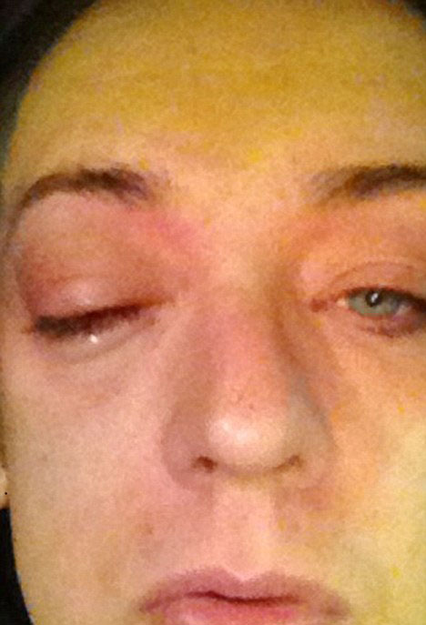 Boy George de olho inchado (Foto: Reprodução/ Twitter)