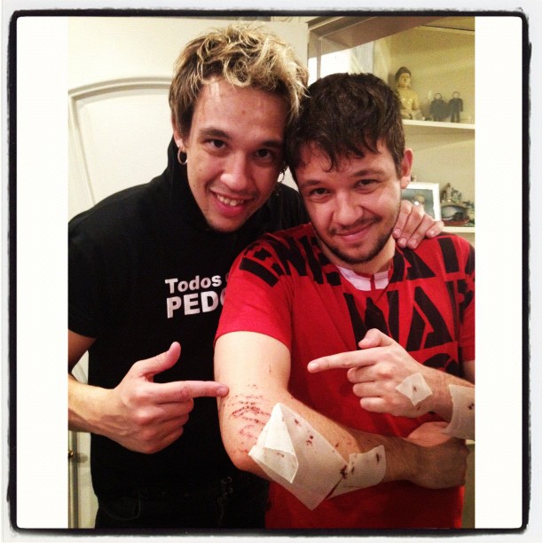 Bruno do KLB mostra machucados (Foto: Instagram)