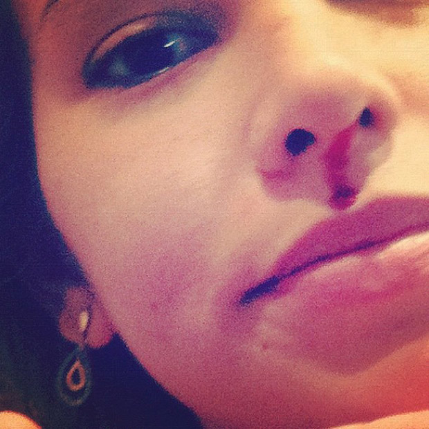 A ex-BBB Adriana posta foto do nariz machucado pela cachorra (Foto: Instagram / Reprodução)