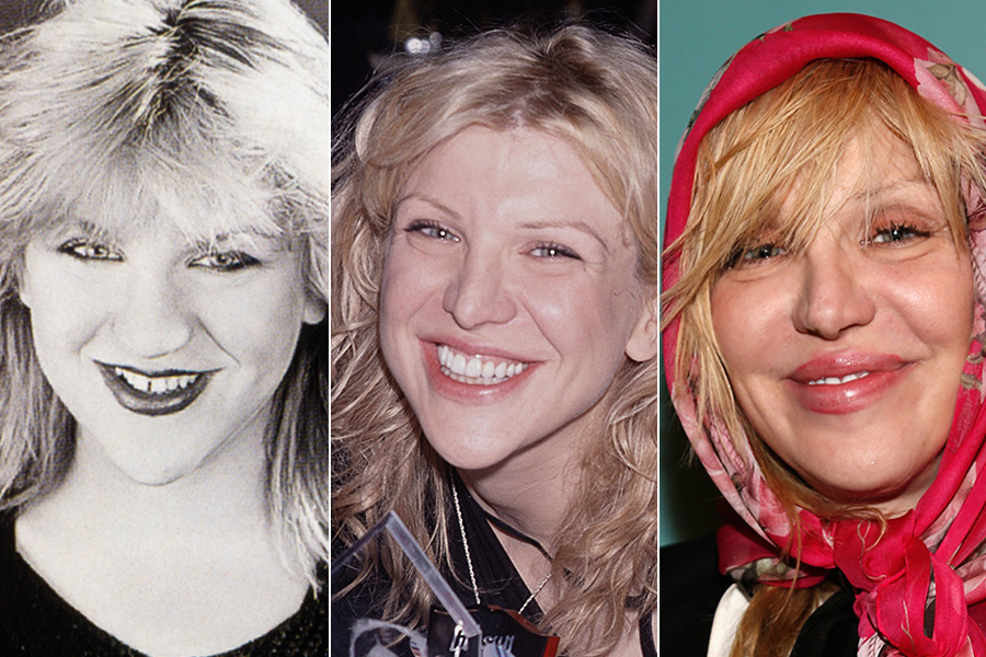 Courtney Love, na juventude, passava longe dos padrões de beleza. Mas, nos anos 90, quando fazia sucesso com o Hole e desfilava como mulher de Kurt Cobain, ela apareceu com os dentes corrigidos e o nariz mais fino. Porém, algo desandou de uns anos para cá
