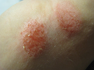 A dermatite é uma inflamação de origem alérgica que causa vermelhidão, lesões e coceira em graus que podem variar de um pequeno incômodo a feridas que exigem internação