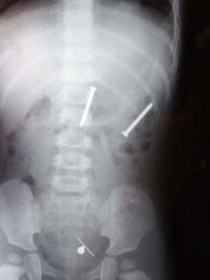 Raio X mostra os pregos no interior do corpo da menina.