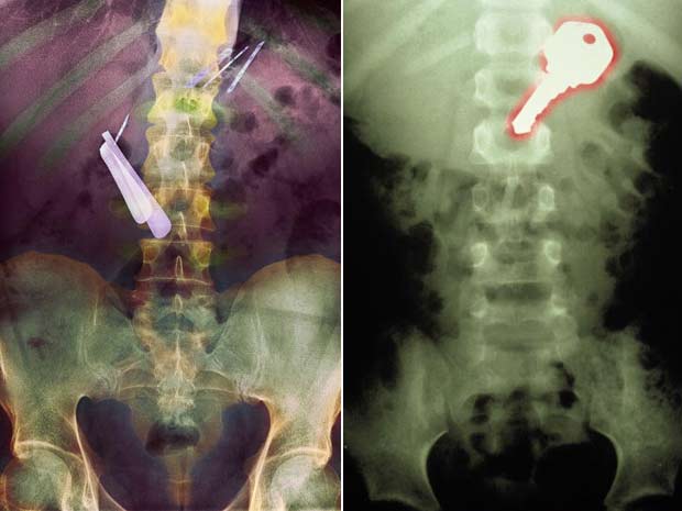 À esquerda, raio-X mostra lâminas de barbear que foram engolidas por um paciente. À direita, imagem mostra uma chave que foi engolida por um menino de 7 anos.