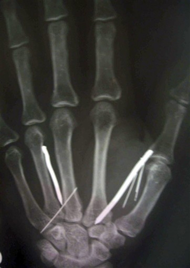 O detalhe de um exame de raios-X mostra pregos enfiados na mão de uma empregada do Sri Lanka, que voltou da Arábia Saudita com 24 pregos dentro de seu corpo, recebendo tratamento em um hospital em Batticoloa, nesta quarta-feira (25).