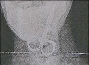 Radiografia mostra a tesoura engolida por Curtis Francis.