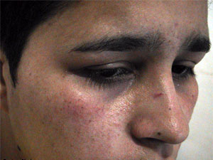 Mulher agredida em lanchonete da Grande São Paulo teve escoriações no rosto e dedo quebrado