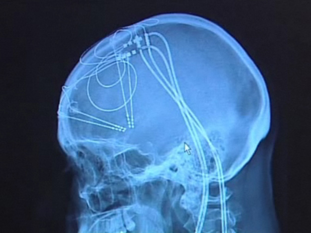 Técnica envolveu o implante de fios e eletrodos no cérebro da paciente
