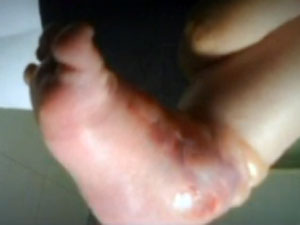 Bolhas em tornozelo de bebê não foram causadas por queimadura, de acordo com o pront-socorro onde ele está internado (Foto: Reprodução/TV Globo)