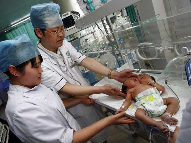 Hospital de Suibing, em Sichuan, sudoeste da China, exibe imagem de gêmeos siameses: corpo único e duas cabeças, que nasceram dia 5 de maio. Segundo médicos, eles estão em estado crítico, com dificuldades respiratórias devido à proximidade das cabeças.  (Foto: AP Photo)