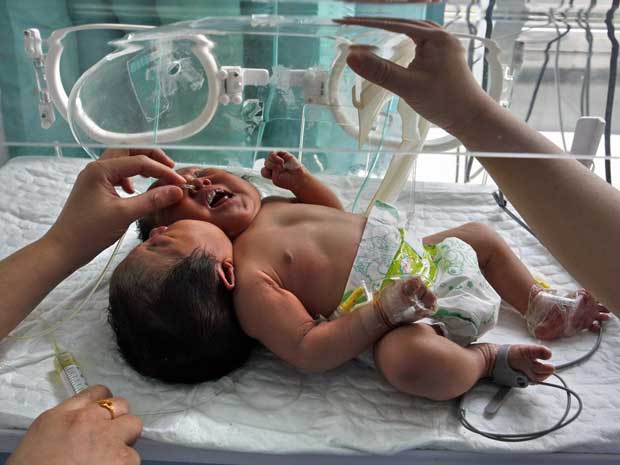 Bebês siameses pesam 4 kg, medem 51cm, têm duas espinhas dorsais, dois esôfagos e compartilham demais órgãos. (Foto: AP Photo)