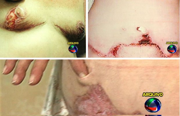 Cicatrizes deixadas nas pacientes que foram submetidas a operações plásticas pelo ex-médico Alberto Rondon, em Mato Grosso do Sul  (Foto: Reprodução/TV Morena)