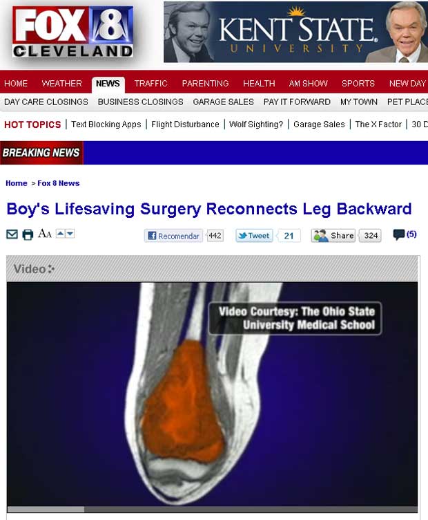 Imagem cedida pela Universidade Estadual de Ohio mostra localização do tumor maligno na perna do garoto (Foto: Reprodução/FOX)