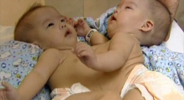 Gêmeas chinesas nasceram unidas pelo peito e pelo abdômen (Foto: BBC)