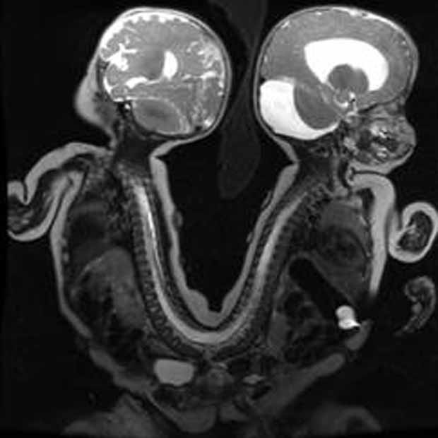 Imagem de ressonância magnética mostra os gêmeos antes da separação (Foto: AP)