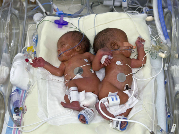 Os irmãos logo após nasceram, em janeiro de 2011. (Foto: Lisa Waddell Buser / Le Bonheur Children's Hospital / AP Photo)