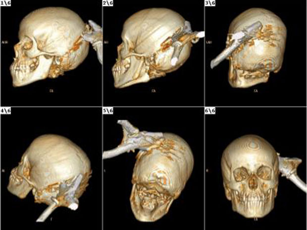 Exame mostra a extensão da lesão na cabeça do menino que teve um alicate encravado na cabeça    (Foto: Reprodução/Reuters)