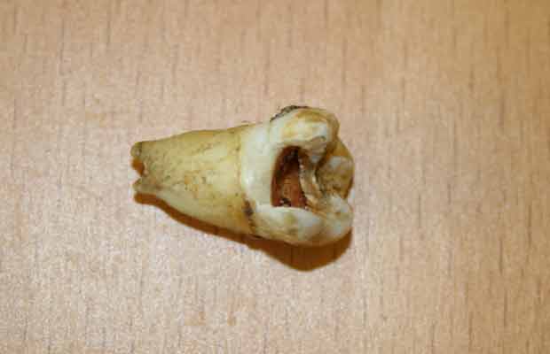 O dente de John Lennon (Foto: Arquivo pessoal)