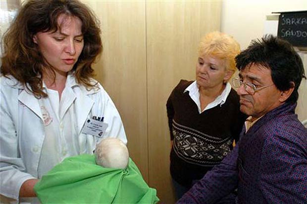 Em 2009, médicos do hospital Kenez Gyula, em Debrecen (Hungria), retiraram uma pedra de 1,125 quilo e 17 centímetros de diâmetro do rim do paciente Sandor Sarkadi. (Foto: MTI,Tibor Olah/AP)