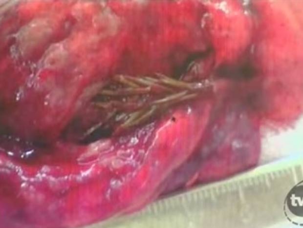 Em 2009, cirurgiões na Rússia acreditavam que iriam retirar um tumor do pulmão de um paciente de 28 anos. No entanto eles encontraram uma planta - de cerca de 5 centímetros - crescendo no interior do órgão do paciente.  (Foto: Reprodução/Vídeo)