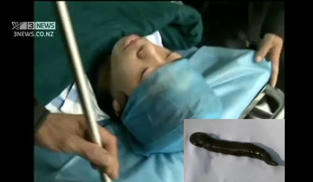 Médicos retiraram uma sanguessuga da traqueia de adolescente chinês. (Foto: Reprodução/3 News)