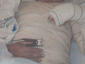 Menino ficou 4 meses internado com queimaduras em Itapetininga. (Foto: Divulgação)
