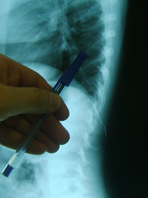 Raio X mostra agulha partida próximo à coluna vertebral, abaixo do pulmão (Foto: Karoline Zilah/G1)