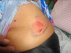 Mulher é mordida por jumento em Paulista (PE) (Foto: Divulgação/Arquivo pessoal)