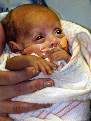 Rumaisa Rahmam em 2004, quando nasceu com apenas 260 gramas. (Foto: Nam Y. Huh / AP Photo)