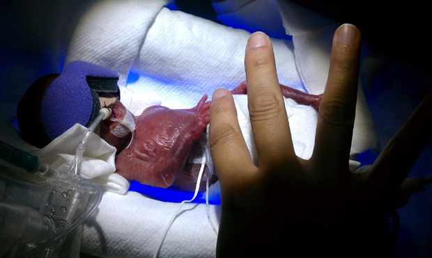 Melinda Star Guido, ao nascer há 14 semanas, com apenas 270 gramas. (Foto: Haydee Ibarra / AP Photo)