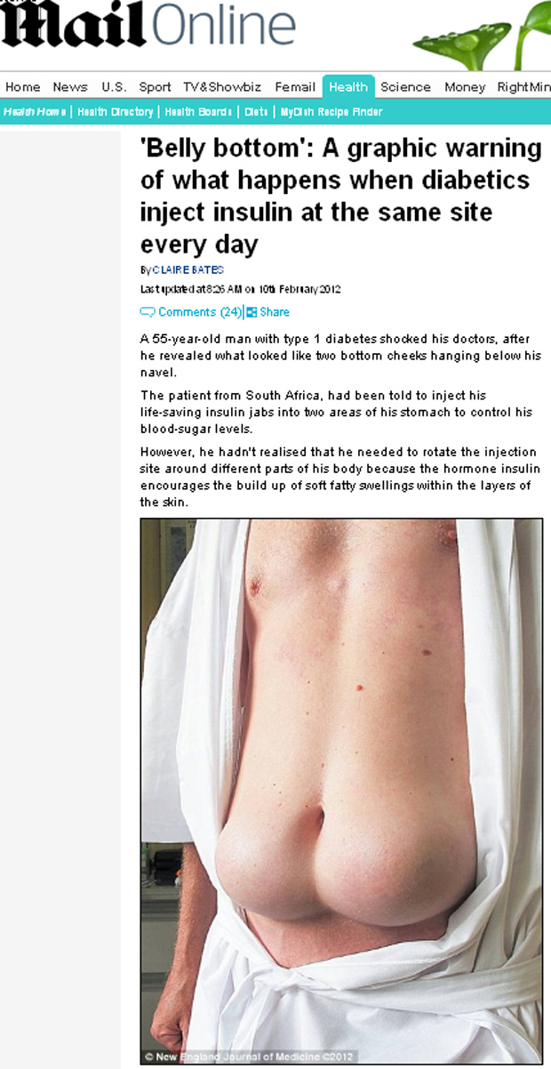 Sul-africano de 55 anos fica com dois inchaços na barriga após três décadas aplicando injeções de insulina no mesmo lugar. (Foto: Daily Mail / Reprodução)
