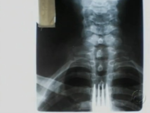 Homem que engoliu garfo morre após rompimento de pontos cirúrgicos (Foto: Reprodução RPC TV)