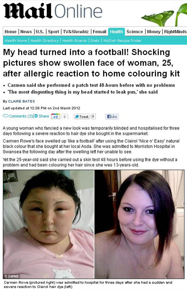 Fotos mostram como é o rosto de Carmen (direita) e como ele ficou (Foto: Reprodução/Daily Mail)