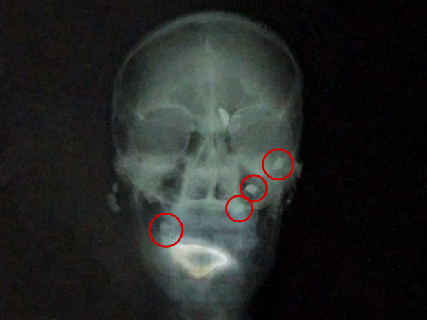 Raio X mostra as quatro balas alojadas na cabeça do homem (Foto: Tatiane Queiroz/G1 MS)