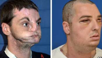 Homem se submeteu ao mais extenso transplante facial  (Foto: AFP)
