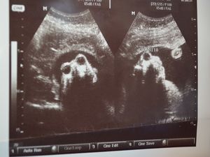 Ultrassonografia mostra situação do bebê (Foto: Flávio Antunes/G1 SE)